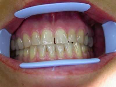 5500 Держатель для губ и щек Optiview, стандартный размер (белые), 2шт. Kerr