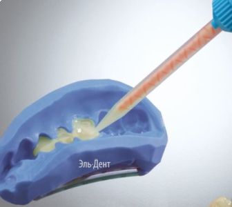 Tempofit premium A1, 10:1 (75 г) композитный материал для изготовления временных коронок и мостов, Detax (Германия)